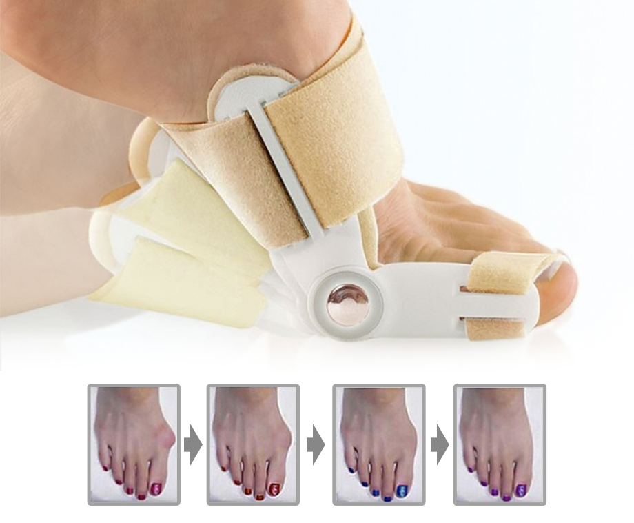 Hallux Valgus Teen Corrector - Verhelpt Pijn Bij Scheefstand Van De Grote T ...